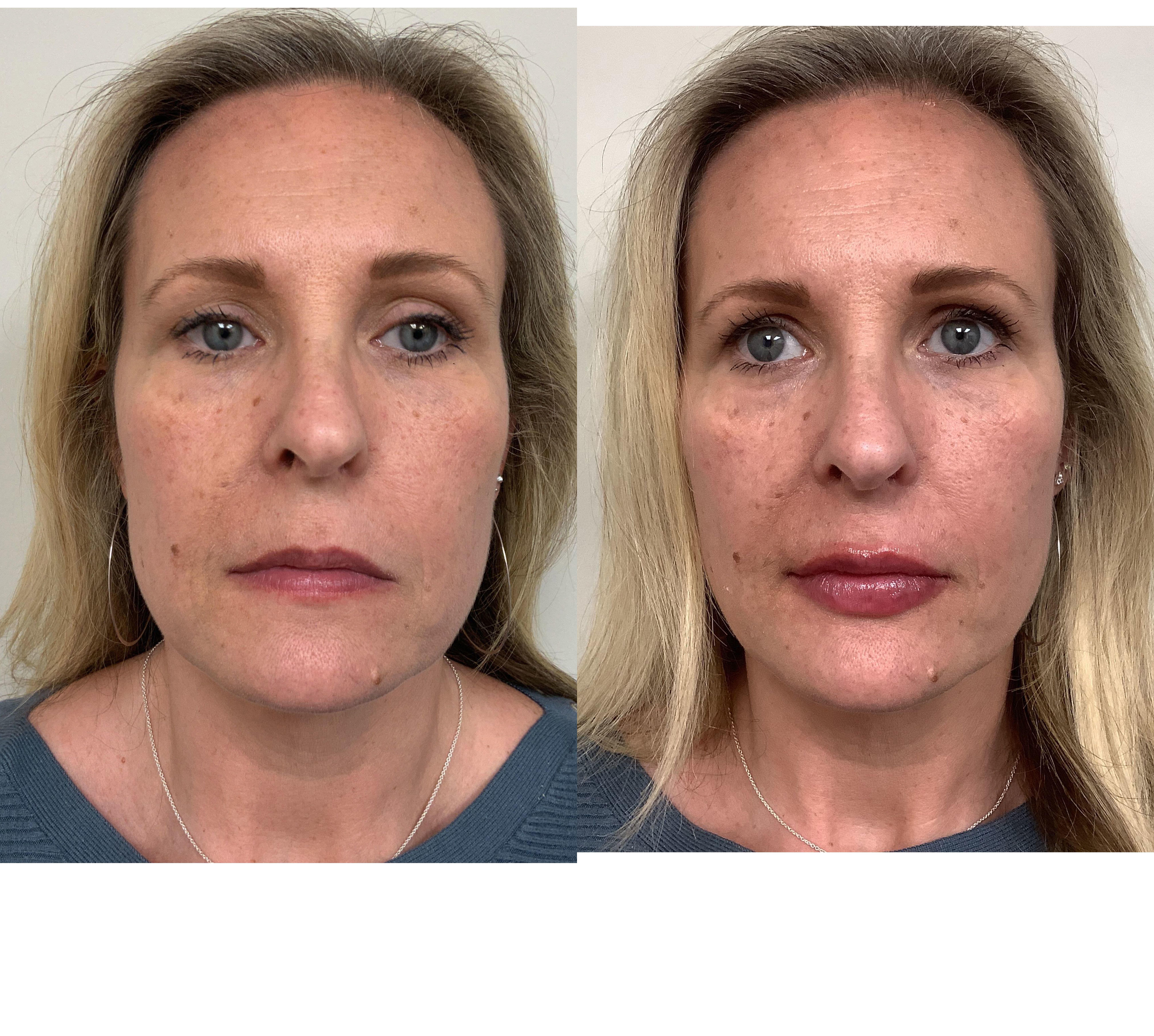 Lip Filler